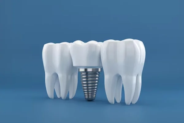 Dental Implants