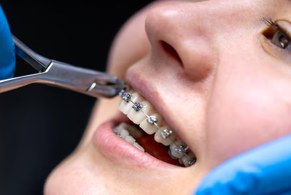 Orthodontic Treatment