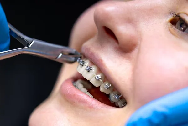 Orthodontic Treatment